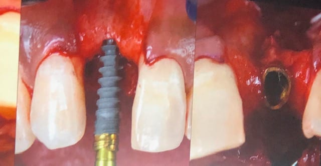 Klinisk innsetting av implantat