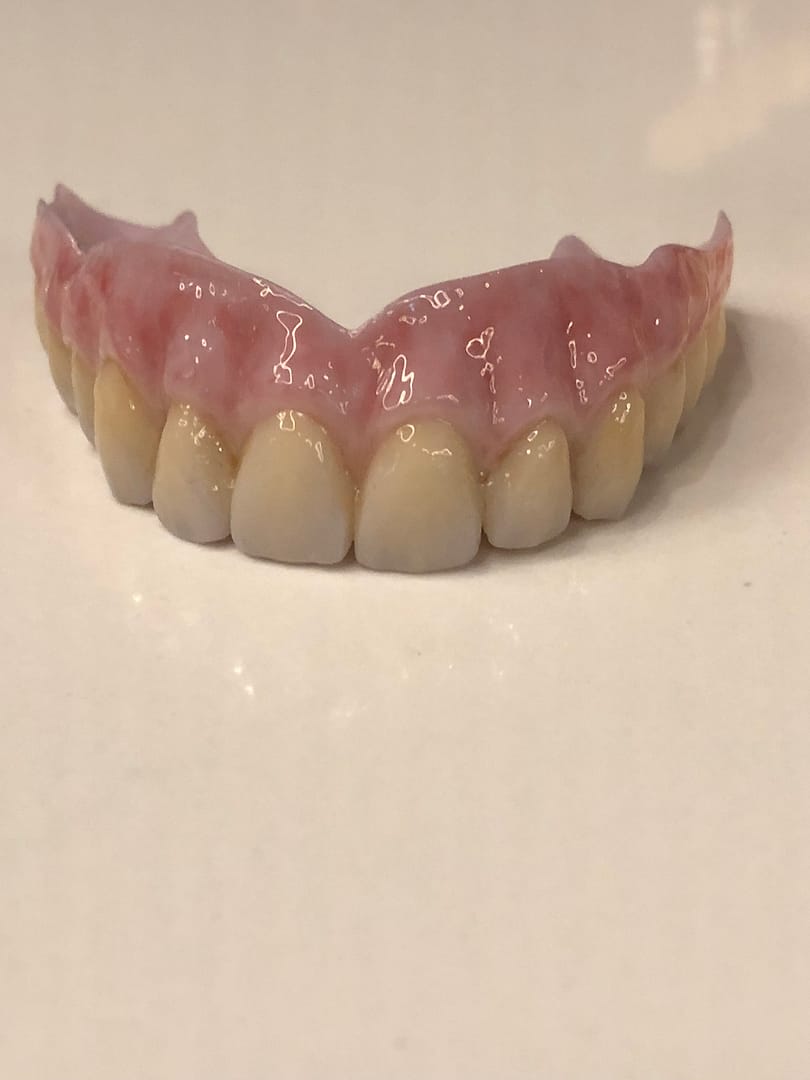 Akryl overdenture